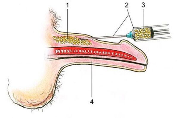 Lipofilling - la introducción de tejido adiposo en el eje del pene