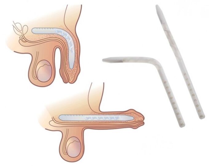 Falloplastia para aumentar un miembro