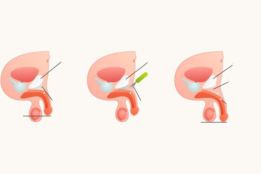 Ligamentotomía para aumentar el pene
