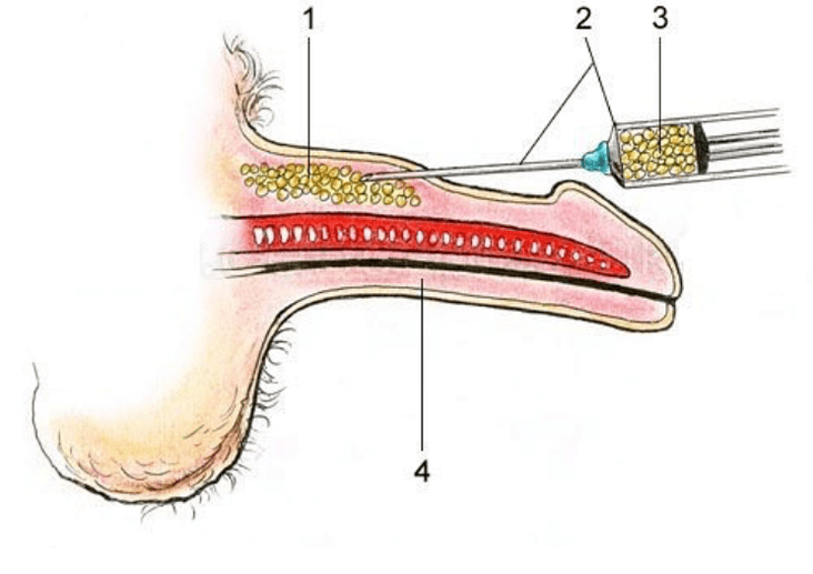 lipofiling para aumentar un miembro
