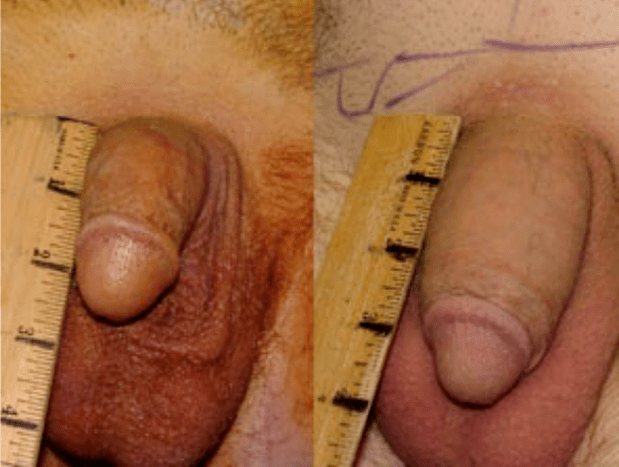 Antes y después del lipofilling y la implantación de gel.