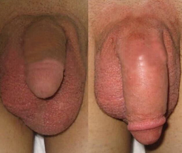 El resultado de instalar una matriz de colágeno en el pene.