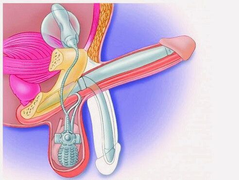 Agrandamiento del pene mediante prótesis de pene