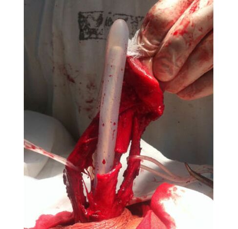 Trasplante de tejido muscular para agrandar el pene.