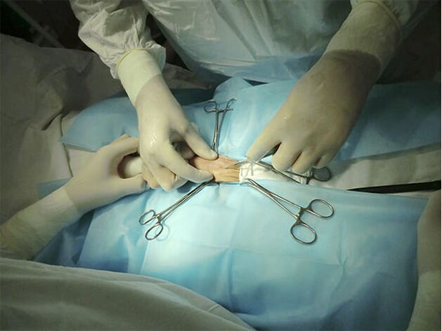 cirugia de agrandamiento del pene