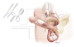 inserción de implantes en el pene